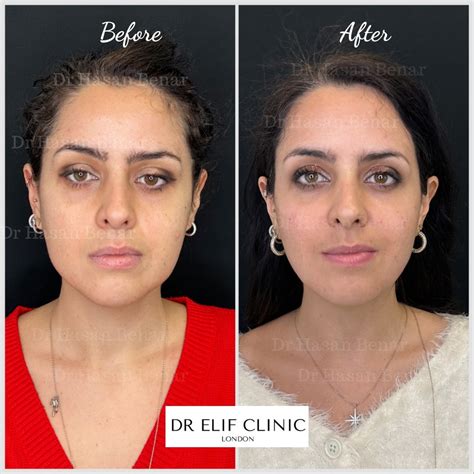 Endolift Non Surgical Facelift With Laser Skin Tightening Anti Aging