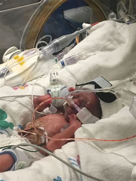 1 Pound Baby Born In Twin Falls At 24 Weeks Local