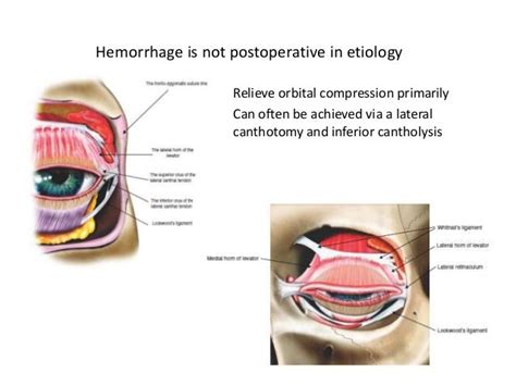 Retrobulbar Haemorrhage