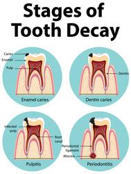 Foods That Damage Teeth And Tooth With Decay Vector Image