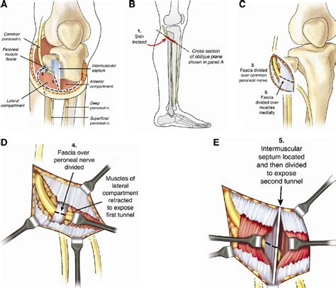 Anterior Tibial Nerve Entrapment