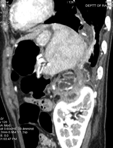 Sagittal Reformatted Contrast Enhanced Ct Image Download Scientific Diagram