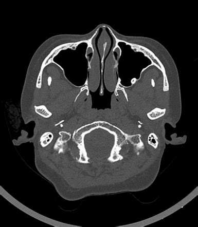 Ectopic Tooth In The Maxillary Sinus Radiology Case Radiopaedia Org