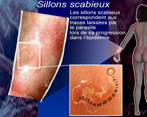 DERMATO INFO La Gale