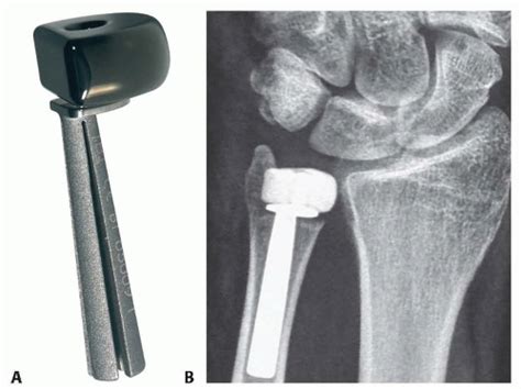 Ulnar Head Anatomy