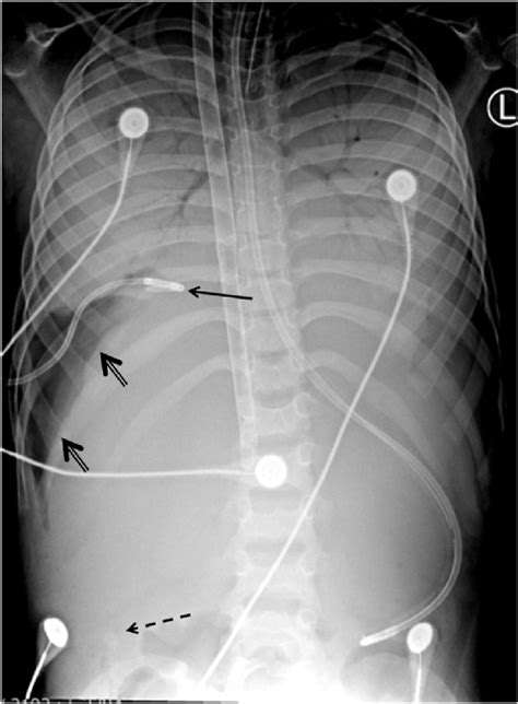 Frontal Supine Portable Chest Radiograph Shows The Venovenous ECMO