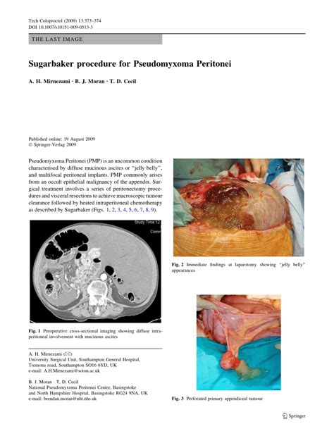 (PDF) Sugarbaker procedure for Pseudomyxoma Peritonei