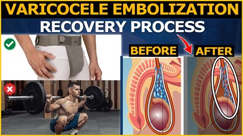 Varicocele Treatment : Your Complete Guide to Varicocele Embolization Recovery Process - YouTube