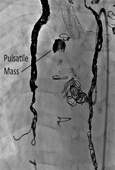 CHSS - Looking In All The Wrong Places: A Pseudoaneurysm Story