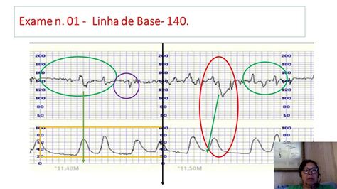 Avaliando Um Exame De Cardiotocografia Fetal YouTube