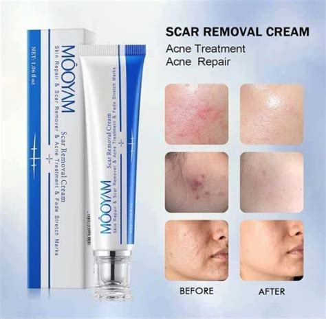 SPEC Tamoskiny Scar Removal Cream | Rapid Repair for Acne & Stretch Marks | 30g - All Skin Types