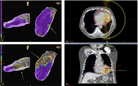 Frontiers Successful Ventricular Tachycardia Radioablation In A