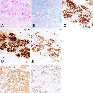 Immunohistochemical Findings Of The Tumor PAS Alcian Blue And MUC5AC