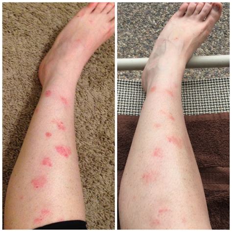 Results after one week on Humira : r/Psoriasis