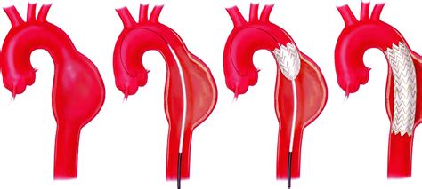 Thoracic And Abdominal Aortic Aneurysms Circulation