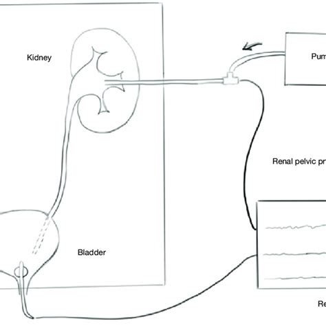 Pdf A Modified Whitaker Test Upper Urinary Tract Videourodynamics