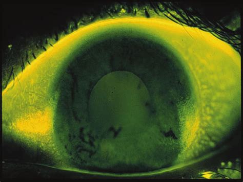 The 3 And 9 Oclock Corneal Staining Induced By Rigid Gas Permeable