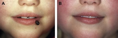 Pyogenic Granuloma Treatment By Shave Excision And Or Pulsed Dye Laser