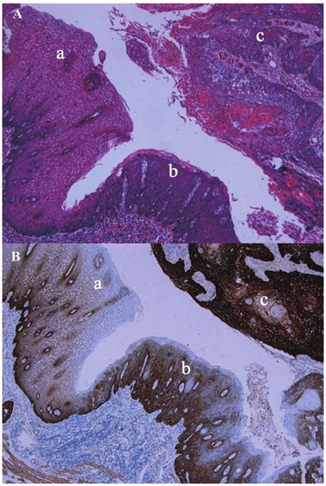 Esophageal Squamous Cell Carcinoma Morphology A Hematoxylin And