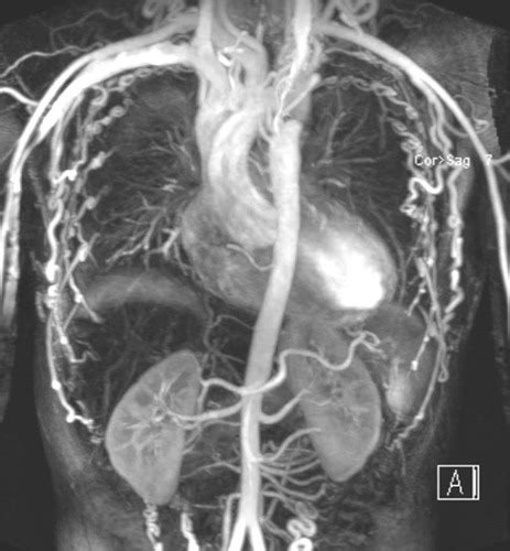 Aortic Coarctation With Extensive Collateral Circulation Circulation Cardiovascular Imaging