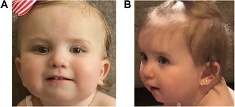 Case Report Prenatal Identification Of A De Novo Mosaic Neocentric