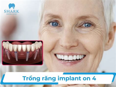 Trồng răng Implant all on 4 là gì Chi phí bao nhiêu