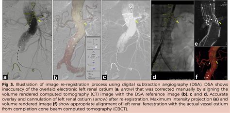 Figure 1 From Computed Tomography Angiographyfluoroscopy Image Fusion