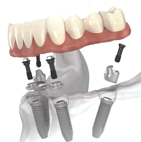 All-on-Four™ Dental Implants Lake Jackson, Brazosport, Angleton – Bell ...