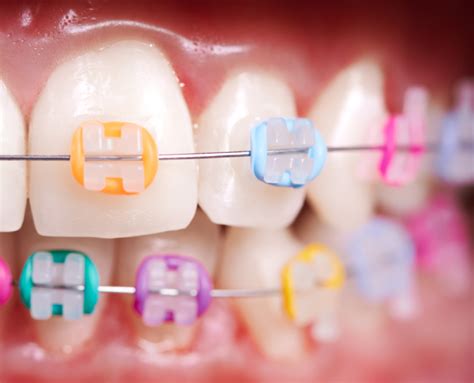 Les avantages dun traitement orthodontique précoce chez les enfants