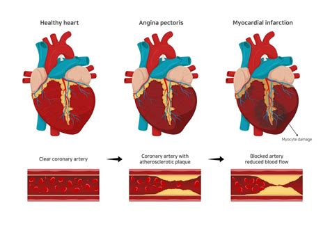 Angina Pectoris Ursachen Und Behandlung