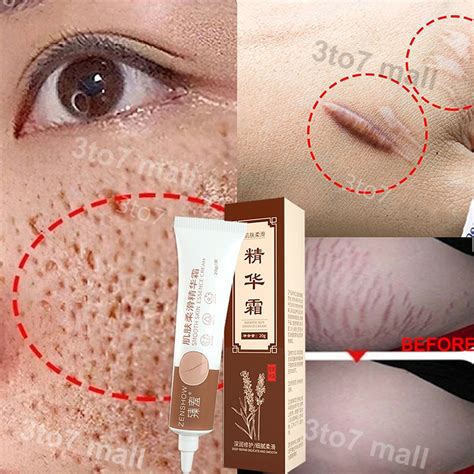 Krim Hilangkan Parut Hitam Menghilangkan Bekas Luka Lama Scar Removal