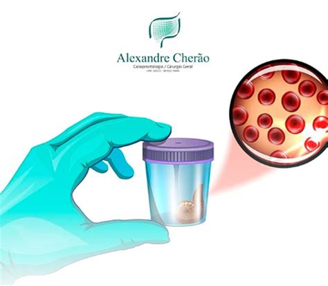 Como É Feito O Exame De Sangue Oculto Nas Fezes