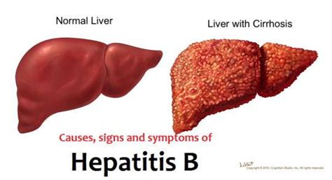 Factoid Friday: Hepatitis B