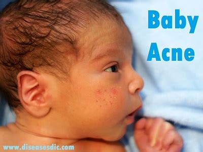 Baby acne – Causes, Types, Treatment and Prevention