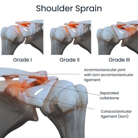 Shoulder Sprain, Strain Treatment in NYC | Shoulder Doctors Specialists