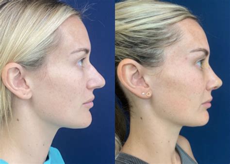 Rhinoplasty Result