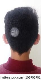 Ringworm Hair Loss Hair Loss Stock Photo 1059029015 | Shutterstock