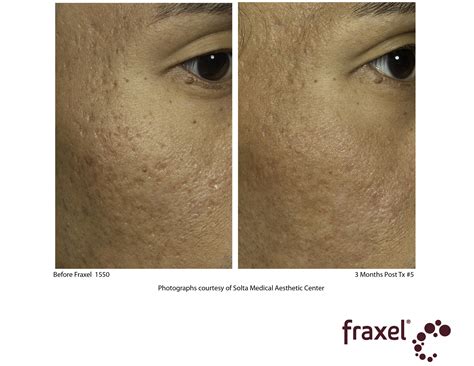 Fraxel Laser Treatment Cost Results Studiomd Midtown Manhattan Nyc