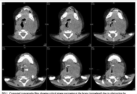 Figure From Managing Limitations Of The Lma Classic Laryngeal Mask As