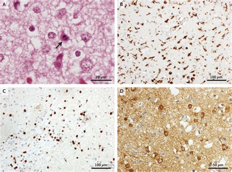 Human Coronavirus OC43 Associated with Fatal Encephalitis | NEJM