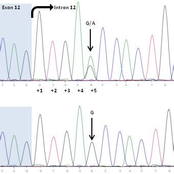 Predicted Amino Acid Sequence Of Normal And Mutant Transcript Deletion