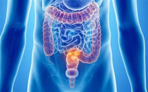 Рак прямой кишки - симптомы, диагностика и лечение в Москве