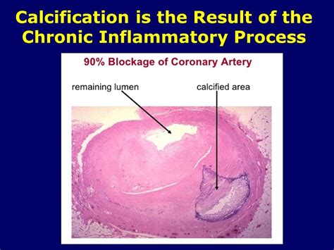 Coronary Calcification Pathology Slide | Advanced Cholesterol Clinic ...