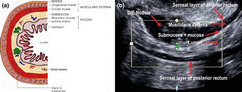 How To Perform An Ultrasound To Diagnose Endometriosis Leonardi