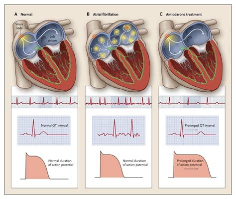 Antidsyrhthmic Medications- Class III: Potassium Channel Blockers Diagram | Quizlet