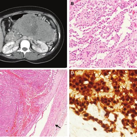 Primary Tumor A Ct Showing The Primary And Pv Thrombus Arrow B Download Scientific