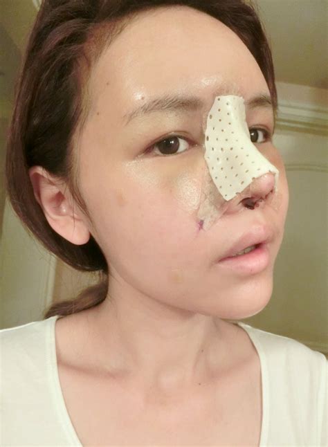 QiuQiu: Day to Day Recovery (Nose Job / Fat Grafting Part 2)