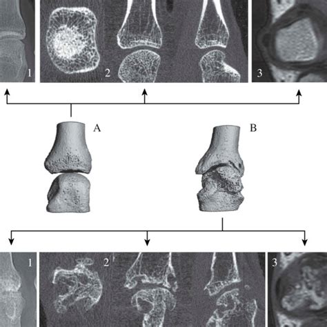 Two Examples Of Metacarpophalangeal Mcp Joints Example A An Mcp Download Scientific Diagram