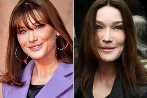 Carla Bruni Les chirurgies esthétiques qu elle a subi