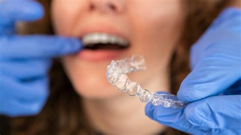 How Does Invisalign Work Your Guide To A Straighter Smile